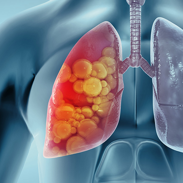 Medical Illustration showing lung cancer or bronchial carcinoma in Ontario, Canada
